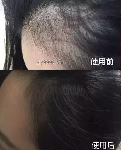 洗头后这个习惯会加重脱发：避免错误干发方式